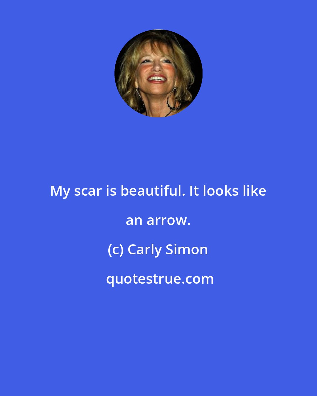 Carly Simon: My scar is beautiful. It looks like an arrow.